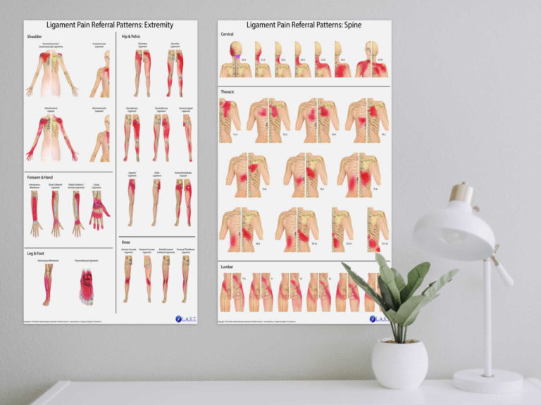 Ligament Pain Referral Patterns Posters - Ligament Pain